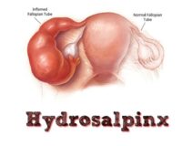 Hidrosalpenks (Tüplerde Sıvı Birikmesi): Nedenleri, Belirtileri ve Tedavisi